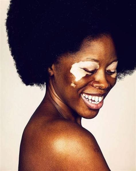 vitiligo nude|8 Girls with Vitiligo Bare All for Brock Elbank Shoot; Share Reactions